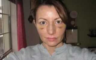 Сколько держится отек после ринопластики