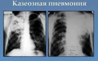 Затемнение в легких после пневмонии