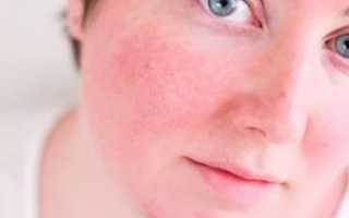 Почему красные щеки у подростка