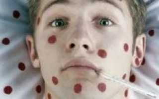 Ветрянка на языке фото