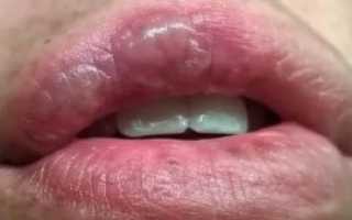 Обожгла небо горячим чаем что делать