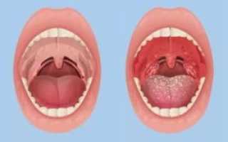 Хронический тонзиллит лечение народными средствами