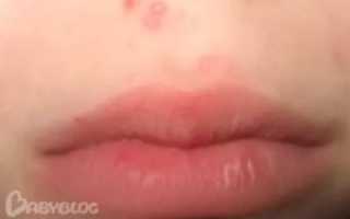 Прыщики под носом у ребенка