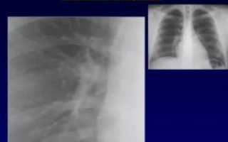 Уплотнение корней легких как лечить