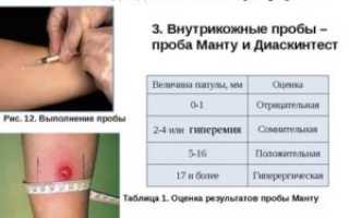 Реакция манту противопоказания у детей
