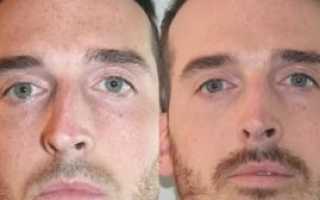 Как выровнять нос без операции