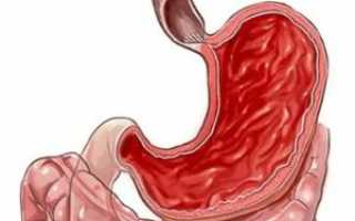 Гиперемия слизистой оболочки