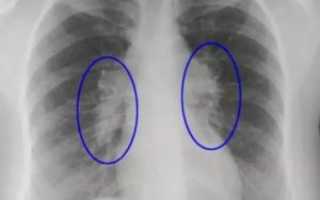 Фиброзные тяжи в легких что это такое