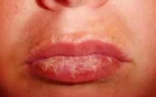 Химический ожог слизистой рта лечение