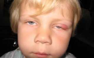 Отек лба и переносицы