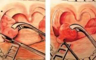 Подрезание миндалин у детей послеоперационный период