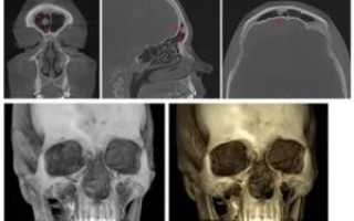 Остеома носовой пазухи