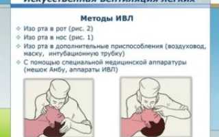 Виды искусственной вентиляции легких
