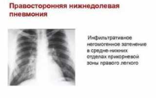 Правосторонняя нижнедолевая пневмония лечение взрослых