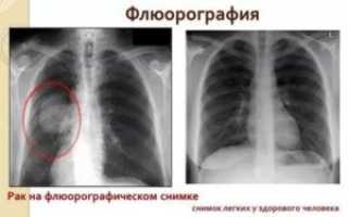 Как проверить легкие кроме флюорографии