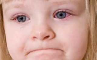 Красные глаза у ребенка при простуде