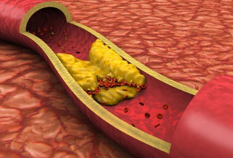 Генерализованный и неуточненный атеросклероз: что это такое?